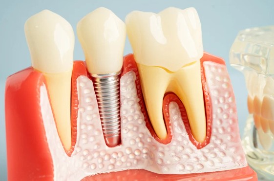 Root Canal Treatment