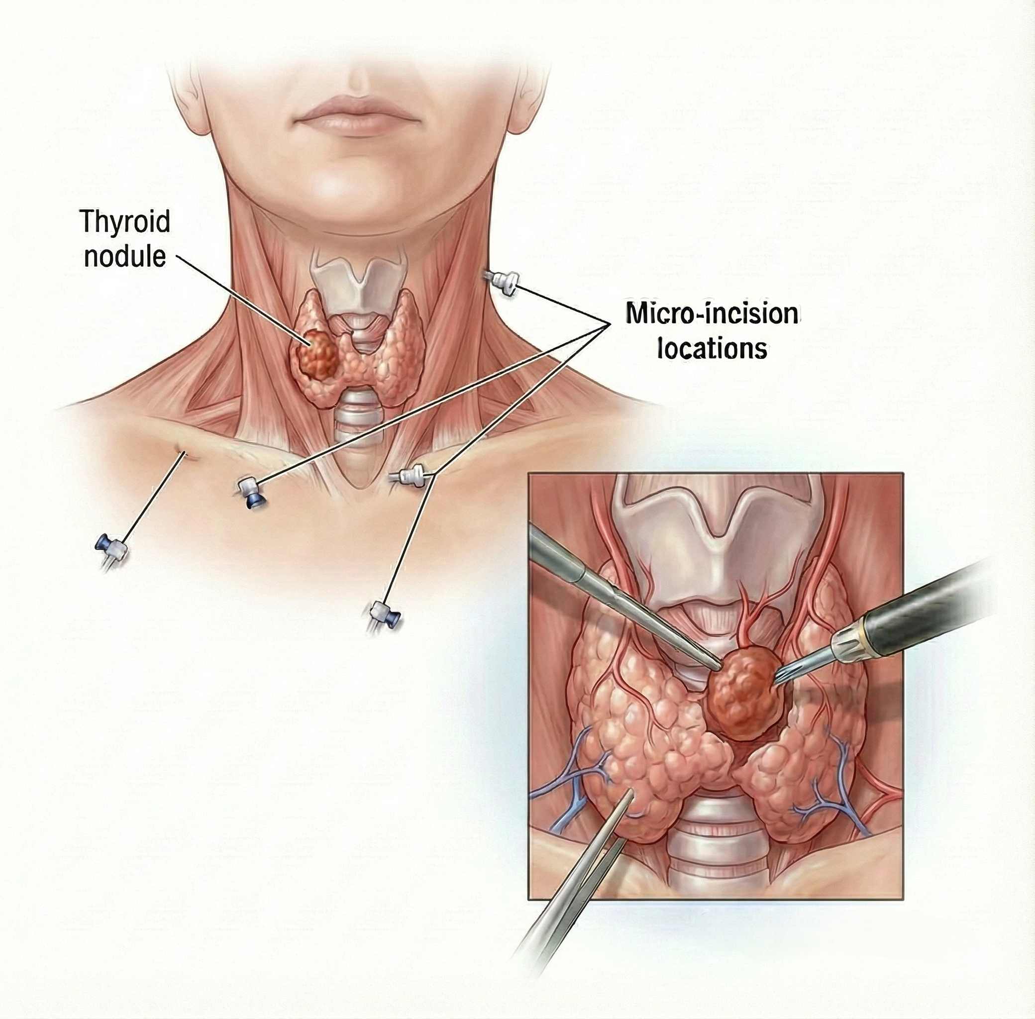 Thyroid Surgery